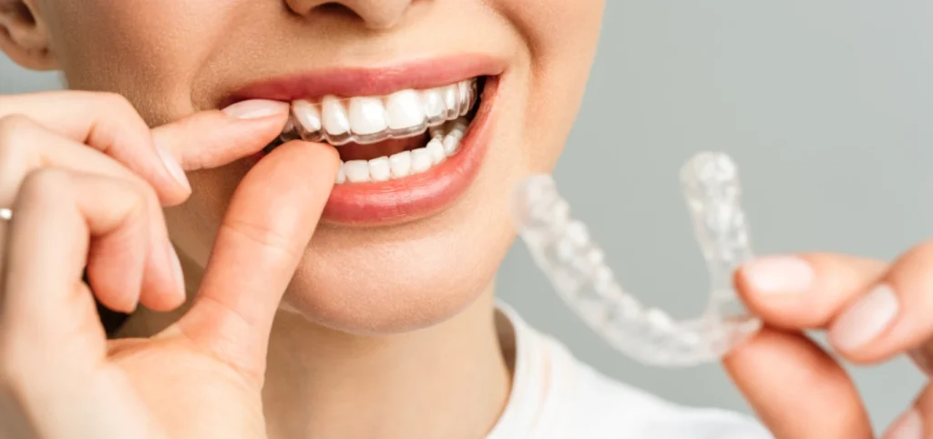 aligneur invisible Orthodontiste adulte Le Barp 33114