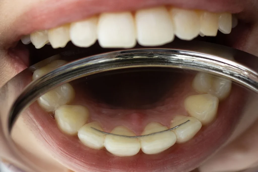 orthodontie contention fil fixe Orthodontiste adulte Le Barp 33114