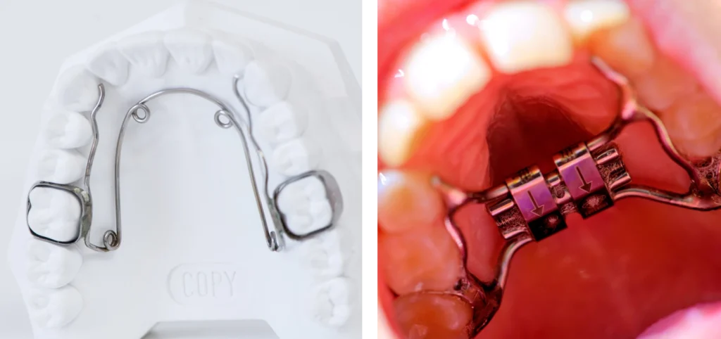 orthodontie enfant disjoncteur quad helix Orthodontiste Le Barp 33114