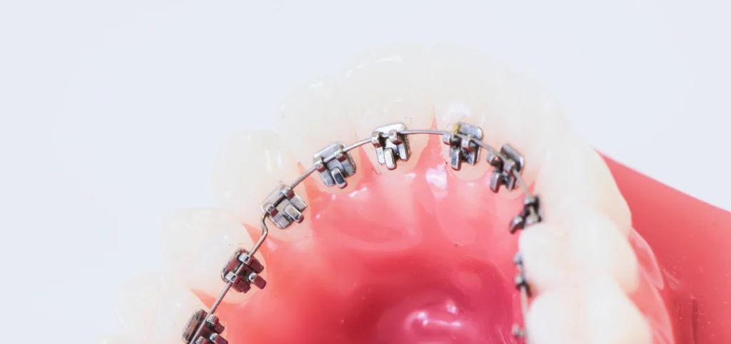 orthodontie linguale Orthodontiste adulte Le Barp 33114